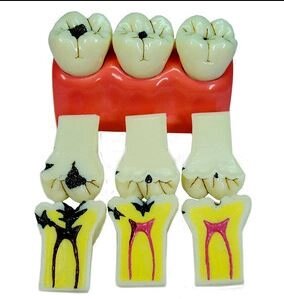 Модель постепенного разрушения зуба