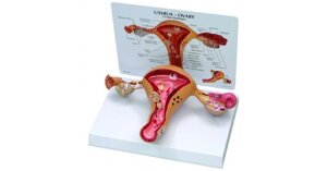Модель заболеваний матки / матка и яичники