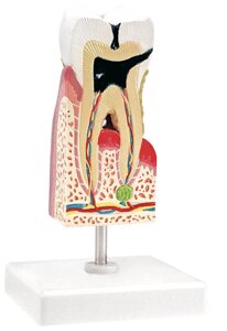 Модель заболеваний зуба на подставке