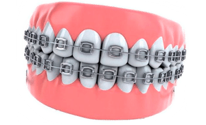 Ортодонтические материалы