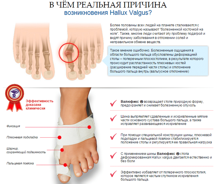 Растущая кость на большом пальце. Деформация стопы hallux valgus. Вальгусная деформация 1 пальца стопы (hallux valgus). Шина от косточки на ноге.