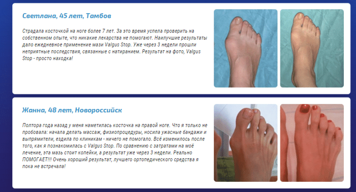 Вальгус большого пальца мази мазь. Вальгусная деформация 1 плюснефалангового сустава. Воспаление косточки на большом пальце ноги.