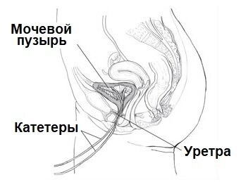 Установка катетеров при цистометрии