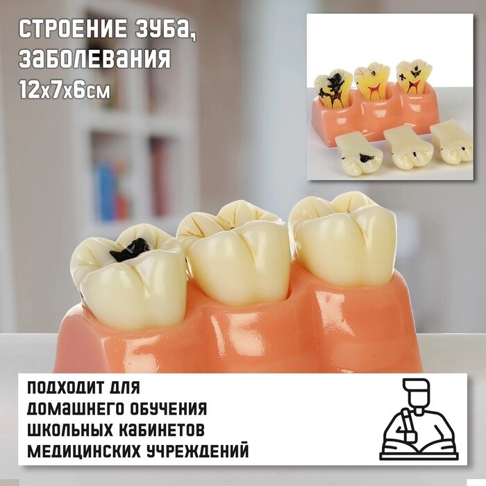 Макет "Строение зуба, заболевания", 12*7*6см от компании Интернет - магазин Flap - фото 1