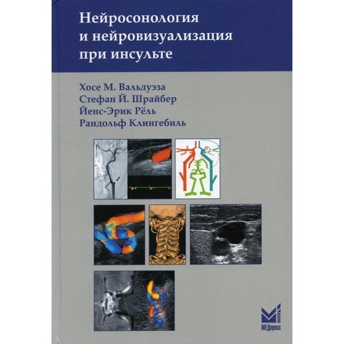 Нейросонология и нейровизуализация при инсульте. 2-е издание. Вальдуэза Х. М., Шрайбер С. Й., Рель Й. Э., Клингебиль Р.